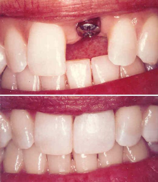 दंत प्रत्यारोपण contraindications