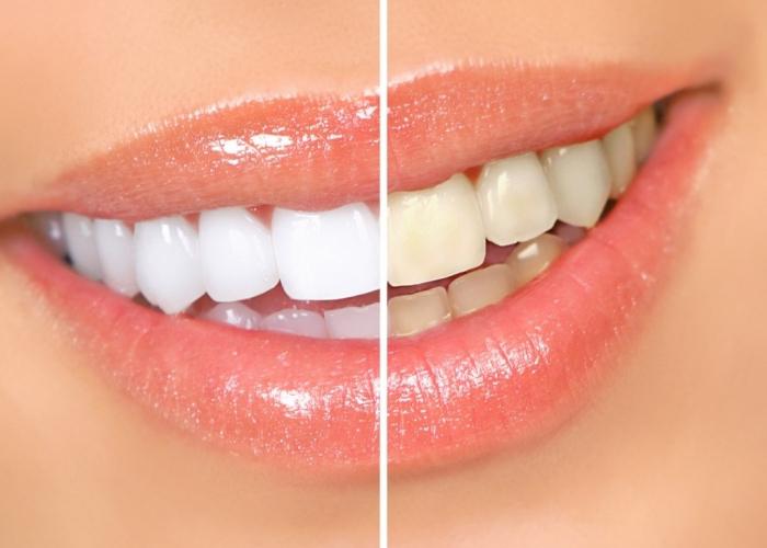 हाइड्रोजन पेरोक्साइड का उपयोग करने के लिए एक असामान्य तरीका: दांतों को चमकना