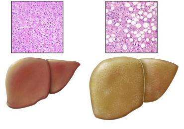 इलाज के मुकाबले यकृत की मोटापा