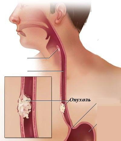 esophagus की cicatricial संकुचन