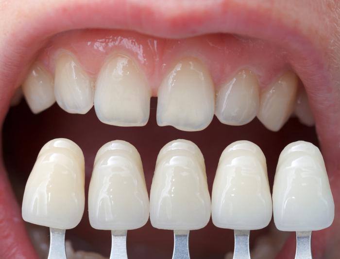 आप अपने दांत कैसे संरेखित कर सकते हैं 